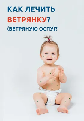 Ветрянка: как распознать? Симптомы и лечение ветряной оспы.