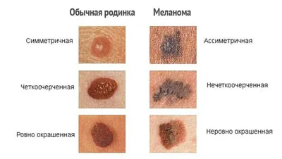 Как отличить опасные родинки от остальных?