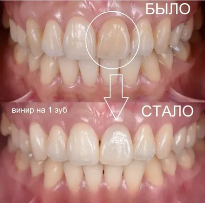 Винир на один зуб фото