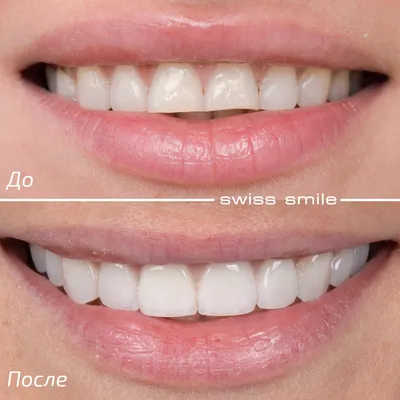 Виниры для зубов в Москве, клиника Swiss-smile результаты до и после
