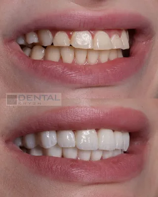 Виниры До После | Стоматология DentalKnysh Львов