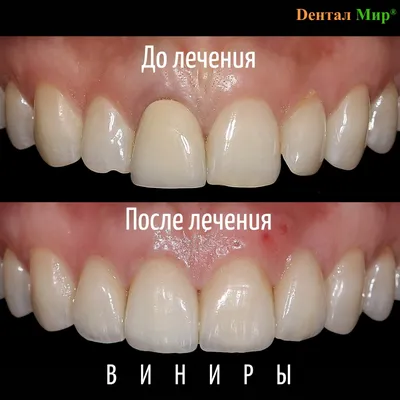 Композитные виниры на зубы: цена в стоматологии в Москве | НоваДент