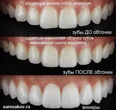 Фото с установленными винирами и коронками | Фотогалерея Deva-Dent