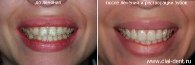 Виниры » MAXTREAT
