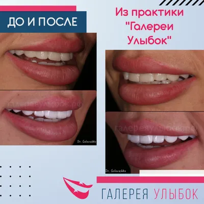 Виниры фото до и после, на передние зубы Екатеринбург, р-н УПИ
