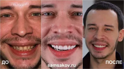 Виниры До и После - YouTube