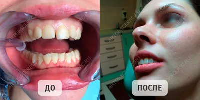 Улыбка на миллион: как выглядели наши звезды до того, как поставили виниры  - Я Покупаю