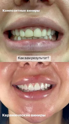 Установка виниров и коронок до и после в стоматологии Smile-at-Once в  Москве. Фото до и после