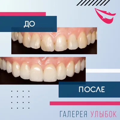Цена на установку керамических виниров на зубы - спецпредложение со скидкой  до 50% в Москве