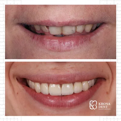 Виниры | Стоматология в Запорожье Dental Studio