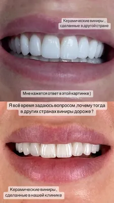 Композитные виниры — что это такое, фото до и после, отзывы, установка  прямым методом