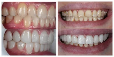 Виниры для зубов в Москве, клиника Swiss-smile результаты до и после