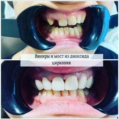 Цена на установку керамических виниров на зубы - спецпредложение со скидкой  до 50% в Москве