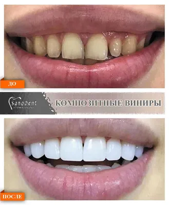 Виниры E.MAX CLASSIC - Центр клеточной и молекулярной стоматологии «Бионик  Дентис»