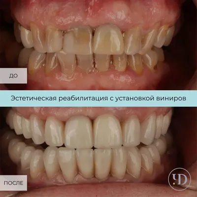 Виниры | Стоматология в Запорожье Dental Studio
