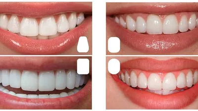 Виниры e-max улучшили форму зубов - стоматология Церекон, Москва
