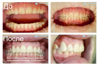 👨 Виниры на все зубы стоимость, сколько стоит протезирование |  Стоматологическая клиника Дантист
