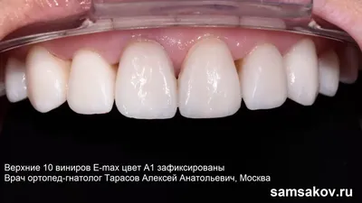 Центр современной стоматологии доктора Крохина - ПРО ЦВЕТ ВИНИРОВ Как  правильно выбрать? ⠀ Самый важный запрос от клиентов, которые устанавливают  виниры в нашей клинике - это то, чтобы зубы смотрелись максимально  естественно😁