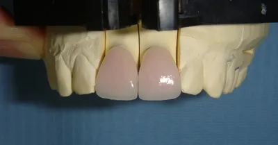 Стоматологические ультратонкие виниры для отбеливания, полимерные зубы,  верхняя передняя часть A1 50 шт. | AliExpress