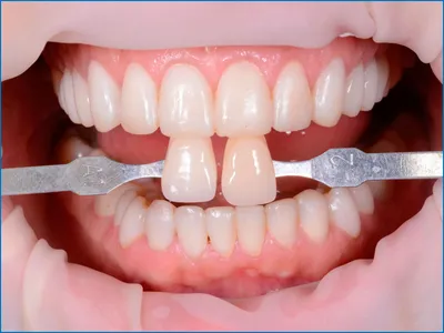 Фото зубов до и после установки виниров и коронок - ECONOMSTOM
