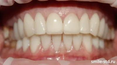 Цвет зубов: фотографии каждого оттенка (Блич 2, Блич 3)