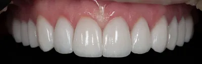 Как определить правильный цвет зубов? - YouTube