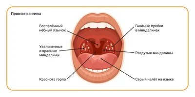 Фолликулярная ангина, лечение и симптомы, заразна ли фолликулярная ангина,  как передается - блог Furasol®