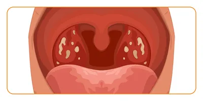 Фолликулярная ангина, лечение и симптомы, заразна ли фолликулярная ангина,  как передается - блог Furasol®