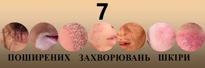 7 поширених захворювань шкіри про які вам потрібно знати