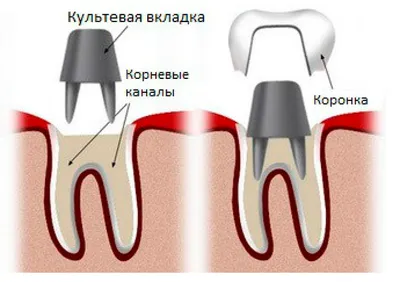 Вкладка в зуб под коронку фото