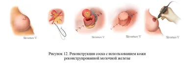 ДОБАВОЧНЫЙ СОСОК МОЛОЧНОЙ ЖЕЛЕЗЫ, ИЛИ ПАПИЛЛОМА КОЖИ?
