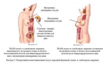 Киста молочных желез: причины, симптомы, лечение