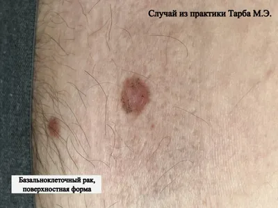 Как распознать рак груди и что делать дальше - Лайфхакер