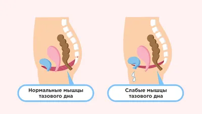Операция кесарево сечение и диастаз живота - Исамутдинова Г. М.