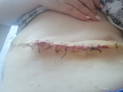 Cosmetic skin suture #2 Шов Холстеда (косметический шов), выпуск 16. 1080р!  - YouTube