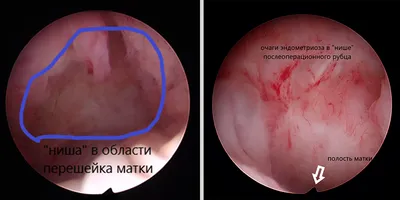 Реконструктивно-пластические операции при эндометриозе послеоперационного  рубца на матке - Медицинский центр «Аква-Минск»