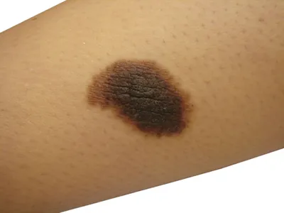 Melanoma Unit on Instagram: \"Внутридермальный невус (он же бородавчатый, он  же папилломатозный) - врожденный или приобретенный доброкачественный пигментный  невус, невусные клетки которого расположены в дерме. Такое образование чаще  всего подвергается ...