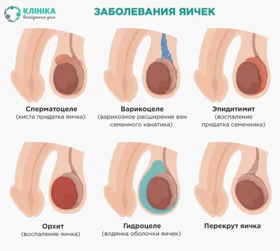 Лапароскопия крипторхизм у детей, лечение, цена хирургической операции. |  Москва