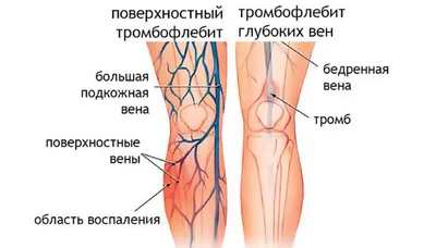 Флеболог | Центр лазерной хирургии \"ПАНАКЕЯ\" Сумы | Варикозная болезнь