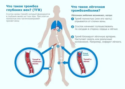 Тромбофлебит – лечение в Москве в клинике доктора Назимовой