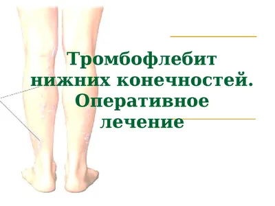 Презентация на тему: \"Тромбофлебит поверхностных вен нижних конечностей.\".  Скачать бесплатно и без регистрации.