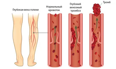 Флеботромбоз: диагностика и лечение в Санкт-Петербурге