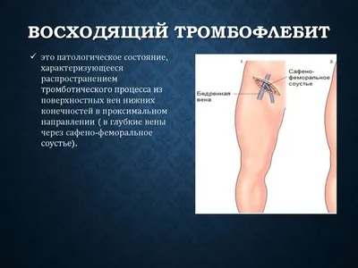 Тромбоз: симптомы, причины, лечение тромбоза вен нижних конечностей,  артерий (глубокий / поверхностный) – Отделение флебологии – НКЦ №2 (ЦКБ  РАН) в Москве