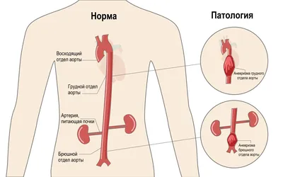 Восходящий тромбофлебит. Ascending thrombophlebitis. Флеболиты. - YouTube