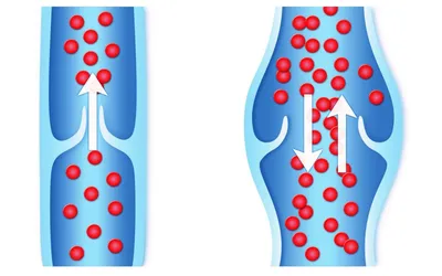 ⛨ Тромбофлебит лечение в Поликлинике № 1 РАН ⛨