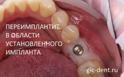 Осложнения после имплантации зубов ТОП1 клиника Москвы - Немецкий  имплантологический центр