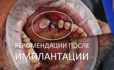 Рекомендации после имплантации зубов - Немецкий имплантологический центр