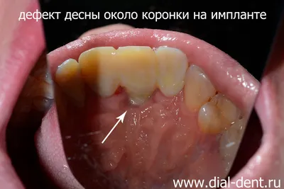 Протезирование передних зубов после имплантации в неправильном прикусе –  исправление чужих ошибок