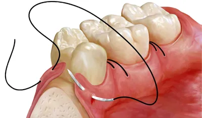 Профилактика осложнений после имплантации | Статьи клиники эстетической  стоматологии Vimontale
