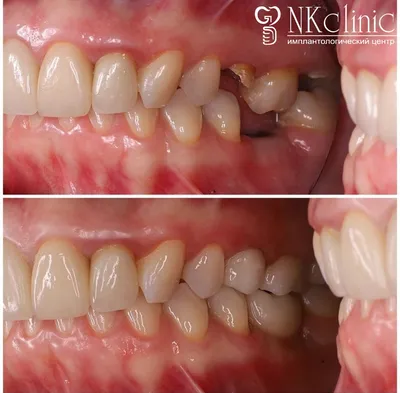 Имплантация зуба после удаления | НК Клиник